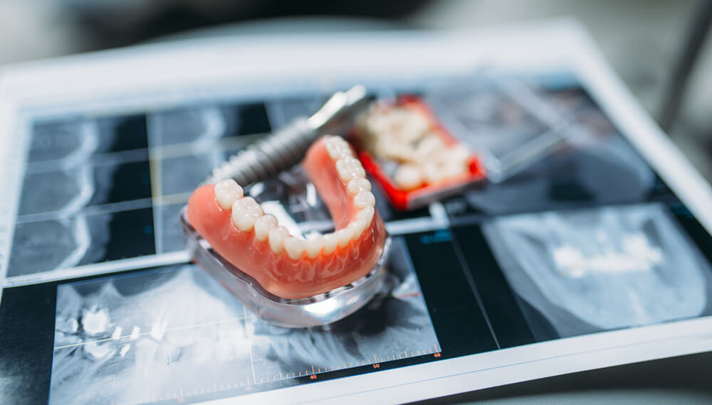 Precision and Innovation in Prosthetics: Unveiling the Excellence of Paulding Dental Prosthetics